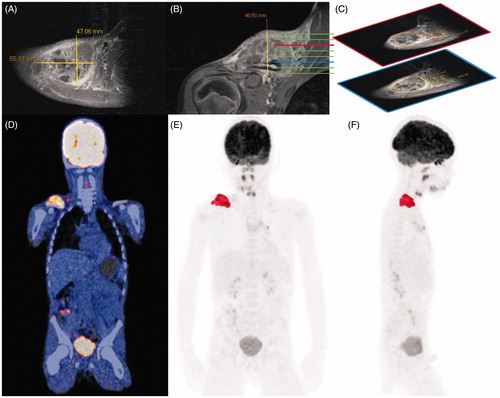 Figure 1. A 9-year-old boy with Ewing sarcoma in and around the right clavicle. Tumor dimension measurements (left-right [LR], anterior-posterior [AP] and cranio-caudal [CC]) are shown on axial (A) and coronal (B) gadolinium-enhanced images. Simplified MRI-based tumor volume was then calculated as LR × AP × CC tumor dimensions × 0.52 [Citation3–6]. Actual MRI-based tumor volume was calculated by first drawing free-hand tumor regions of interest on each axial slice (two slice examples are shown (C), multiplying tumor area by the slice thickness for each slice and then summing the tumor volumes of the slices. Coronal FDG-PET/CT (D) shows the tumor to be FDG-avid relative to mediastinum and liver. Using in-house-developed software (ACCURATE), supervised automated tumor segmentation was performed and MATV (50% threshold of SUVpeak corrected for local background) was calculated [Citation9,Citation10]. Segmentation results are shown on coronal (E) and sagittal (F) maximum intensity projection images.