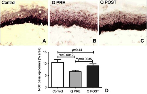 Figure 6 Immunohistochemistry in skin biopsies for NGF, before and after capsaicin 8% patch treatment. NGF immunostaining of basal epidermis in calf skin obtained from (A) control subjects, and CIPN patients before (B, Q PRE) and after capsaicin 8% patch treatment (C, Q POST), magnification x40. (D) Bar chart showing the basal cell NGF image analysis (% area).