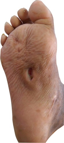 Figure 1 An ulcerated wound on the sole of right foot, measuring 5×4 cm.