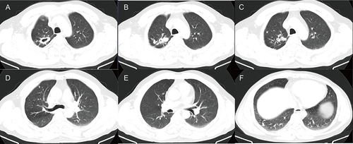 Figure 2 The CT images of DS-TB patients. (A–F) A 43-year-old man had repeated cough and expectoration for 3 years, and the recurrence worsened for more than 2 months. The sputum smear was positive, and the diagnosis was tuberculosis. CT images showed several small solid nodules of different sizes scattered in the upper lobe of the right lung, along with two hollow shadows in the same lobe. The cavity range was relatively small, a few cavities were observed in the lower lobe of the right lung. (A) Large cavity shadow (arrow) in the apical segment of the upper lobe of the right lung. (B) Large solid nodule (arrow) in the upper lobe of the right lung. (C) Small cavity shadow in the upper lobe of the right lung (arrow). (D and E) Small solid nodule (arrow) in the upper lobe of the right lung (arrow). (F) Small cavity shadow in the lower lobe of the right lung (arrow).