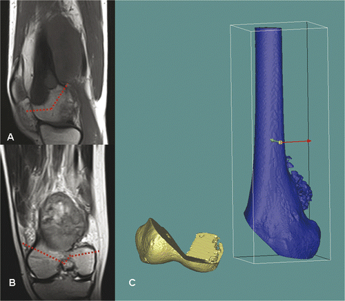 Figure 7. For Patient 3, sagittal (A) and coronal (B) MR images showed a low-grade parosteal osteosarcoma involving the right distal femur. The tumor mainly involved the anterior part of the medial femoral condyle; the lateral and posteromedial femoral condyles were spared. It was therefore possible to precisely plan a multi-planar resection that preserved the lateral collateral ligaments at the lateral femoral condyle and also the insertion of the cruciate ligments at the femoral intercondylar notch. These soft tissue attachments are important for knee stability and the blood supply of the distal femur bone remnants when a joint-sparing tumor resection and reconstruction is contemplated. The resection was planned and simulated on the reconstructed 3D distal femur model in the MIMICS software (C).