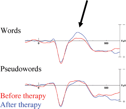 Figure 5 Neurophysiological changes induced by intensive language action therapy in chronic aphasic participants. A brain potential elicited by written words at a latency of∼250 ms increased significantly over a short therapy period. No comparable change was seen for meaningless pseudowords. The word‐specific increase of this “Aphasia Recovery Potential” correlated with the improvement on a clinical language test and its sources were localised in both cortical hemispheres (after Pulvermüller et al., Citation2005b).