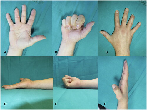 Figure 4. Tamai zone 1 fourth finger reconstruction 1 year post. (A) Extension in volar view; (B) Flexion in volar view; (C) Extension in dorsal view; (D) Extension in ulnar view; (B) Flexion in ulnar view; (F) Extension in radial view.