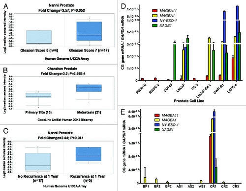 Figure 1.MAGEA11 expression in human prostate cancer. (A-C) Oncomine analysis of MAGEA11 expression. Fold change, P-value, and microarray platform is indicated, and the title shows the first author of the referenced studies Citation61, Citation62. Data are presented as a box and whiskers plot, with the box indicating the 25th to 75th percentiles, whiskers indicating the 10th and 90th percentiles, top and bottom points indicating the range, and center line indicating the median. (A) MAGEA11 expression as a function of prostate cancer Gleason grade. (B) MAGEA11 expression in primary and metastatic prostate cancer. (C) MAGEA11 expression as a function of prostate cancer recurrence at one year. (D) Expression of MAGEA11 and three representative CG antigen genes, MAGEA1, NY-ESO-1 and XAGE1 in prostate cell lines was measured using RT-qPCR. PWR-1E and RWPE-2 are cell lines derived from benign prostate epithelium, while the other cell lines were derived from prostate cancers. (E) Gene expression was measured as described in (D), using primary tissues derived from benign prostatic hyperplasia (BP), androgen-stimulated prostate cancer (AS), and castration-recurrent prostate cancer (CR). Absence of a bar indicates that no expression was detected.