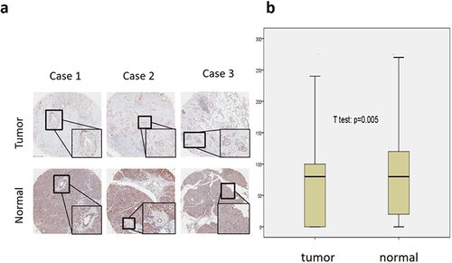 Figure 1 (a) hENT1 expression level in tumor and normal tissues. (b) hENT1 staining in tumor tissues was significantly lower than that in paired normal tissues (80.5±8.8, 95% CI 71.7–89.2 versus 89.5±8.9, 95% CI 80.6–98.4; p=0.005).
