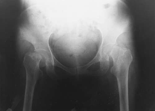 Figure 1. Bilateral femoral neck fracture of this patient.