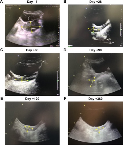 Figure 4 Pelvic ultrasound results of the patient before and after CAR T-cell therapy.