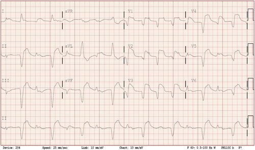 Figure 1 BiVT secondary to fulminant myocarditis. LBBB, ventricular axis is alternating between left axis at −45 degrees and right axis at +90 degrees.