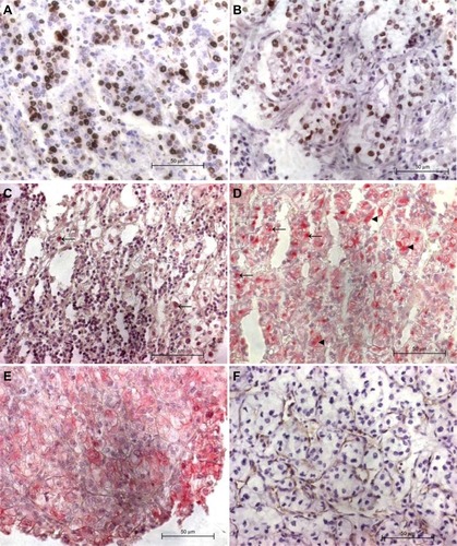 Figure 1 Representative ccRCC cores with positive immunohistochemical stainings.
