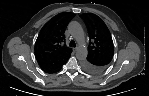 Figure 1. Calcified hilar lymph nodes and a large left-sided pleural effusion seen on CT chest without contrast
