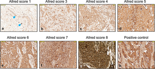 Figure 1 Lipocalin 2 (LCN2) staining scored with the Allred scoring in different breast cancerous tissues. (a) Cytoplasmic staining with Allred score 1 in ductus epithelium and stroma of normal breast tissue (blue arrow), (b) Cytoplasmic and membranous staining with Allred score 3 in tumor cells in a case with Luminal A, (c) Allred score 4 in tumor cells in a case with Luminal A, (d) Allred score 5 in tumor cells in a case with Luminal B, (e) Allred score 6 in tumor cells in a case with Luminal B, (f) Allred score 7 in a case with TNBC, (g) Allred score 8 LNC2 expression in a case with tumor cells of TNBC, (h) LCN2 positive control (colon adenocarcinoma). All figures are at 100 µm magnification.