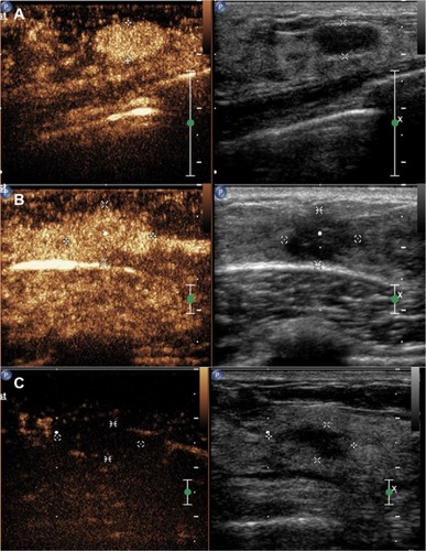 Figure 3 The benign sub-models of contrast-enhanced ultrasound for breast lesions. (A) Rapid wash-in with hyper-enhancement and clear margin after enhancement without enlarged size. (B) Synchronous or slow wash-in with iso-enhancement, and no difference in margin and shape after enhancement. (C) Synchronous or slow wash-in with hypo-enhancement.