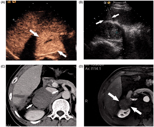 Figure 1. Microwave ablation (MWA) in a 56-year-old man with metastatic hepatocellular carcinoma in the right adrenal gland. (A) Contrast-enhanced ultrasound (CEUS) before MWA shows obvious enhancement in the arterial phase (arrow). (B) Antenna placement during the ablation of the right adrenal metastasis. (C) Computed tomography (CT) imaging obtained 6 days after MWA showed no enhancement (arrow). (D) Follow-up contrast magnetic resonance imaging (MRI) 1 year after MWA showed no enhancement of the target tumour.