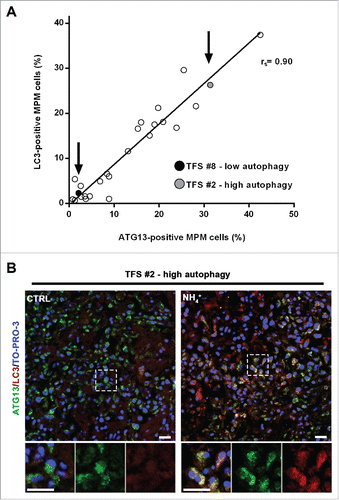 Figure 6. In tumor fragment spheroids, autophagy initiation correlates with the autophagic flux. (A) TFS exposed to NH4+ were stained for LC3 and the same TFS not exposed to NH4+ were stained for ATG13; both were stained for KRT/cytokeratin to identify the mesothelioma cells. The correlation plot of the percentages of LC3-positive MPM cells (y axis, TFS grown in the presence of NH4+) relative to that of ATG13-positive MPM cells (x axis, TFS grown without NH4+) is shown. Arrows identify the position of the representative low autophagy TFS (#8, black circle) and high autophagy TFS (#2, gray circle), previously shown on Figures 4 and 5. Spearman rank correlation (rs), 0.8997; P (2-tailed)< 0.0001. (B) TFS grown in the presence or absence of NH4+ for 12 h were stained for ATG13 (green), LC3A/B (red), and nuclei (blue) and imaged by confocal microscopy. ATG13 and LC3A/B double immunostaining images of a representative TFS with high autophagy levels (TFS #2) grown in the presence (NH4+) or absence of the lysosomal inhibitor (CTRL) are shown. Zoom-in views of the regions in the dashed boxes are shown for representative cells. Scale bars: 10 µm.