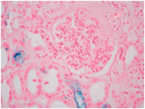 Figure 3. Glomerulus with fibrous crescent and tubular epithelial cells showing hemosiderin deposition (Prussian blue stain ×200).