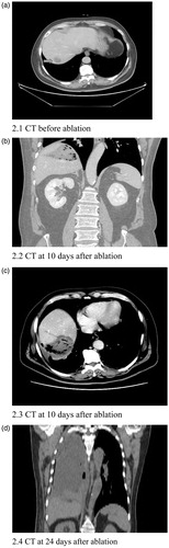 Figure 2. A 59-year-old male patient underwent ablation of a metastatic lesion in the right lobe of the liver 2 years and 1 month after surgery for ampullary carcinoma. Following ablation, the patient developed intermittent fever and chills. An abdominal CT scan at 10 days after ablation shows an abscess in the ablation area; the lung CT scan at 24 days after ablation shows a right empyema.