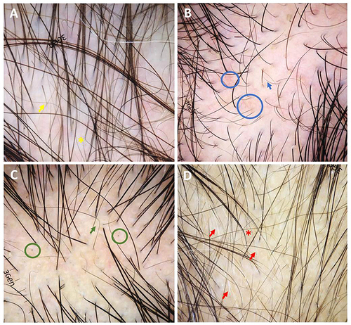 Figure 2 Trichoscopic features of alopecia areata (original magnification x20): (A) exclamation mark hair (yellow arrow), angulated/zigzag hairs (yellow star), and hypopigmented hair shafts; (B) exclamation mark hair (blue arrow) and telangiectasia (blue circles); (C) angulated/zigzag hairs (green arrow) and black dots (green circles); (D) exclamation mark hairs, tapered hairs (red star), and non-pigmented regrowing hairs (red arrows).