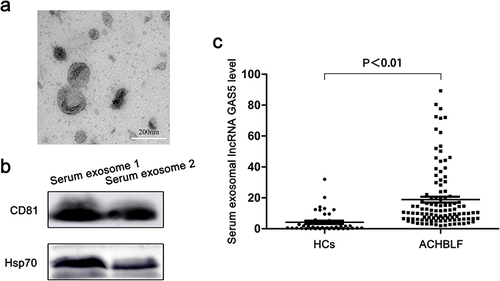 Figure 2 The expression of lncRNA GAS5 in serum exosomes was elevated in patients with ACHBLF. (a) The representative image of serum exosomes analyzed by TEM. (b) Exosomal markers CD81 and Hsp70 were detected using Western blot. (c) The expression level of serum exosomal lncRNA GAS5 in patients with ACHBLF and HCs.