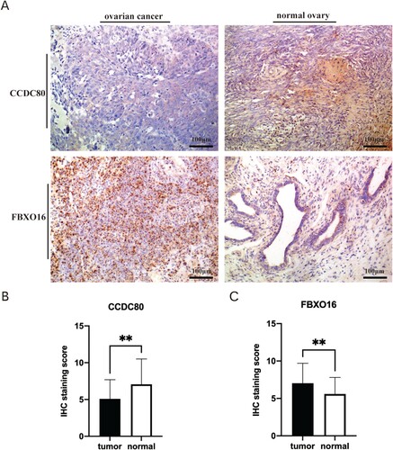 Figure 7. (A) Representative Immunohistochemical photographs stained with CCDC80 and FBXO16 in ovarian cancer tissues and normal ovarian tissues (B) The IHC staining score of CCDC80 in ovarian cancer tissues compared to the scores in normal ovarian tissues (P<0.05). (C) The IHC staining score of FBXO16 in ovarian cancer tissues compared to the scores in normal ovarian tissues (P<0.05).