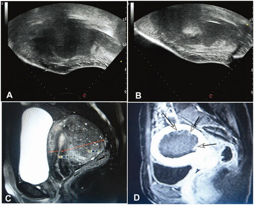 Figure 2. Before HIFU ablation, the lesion of adenomyosis is in the posterior wall of uterus with low echo (A). After HIFU ablation, the echo of adenomyosis turns white(B); Before HIFU, the T2WI MRI shows the adenomyosis in the posterior wall of the uterus with hypointensity signal and hyperintensity pot sac signal (C); On contrast enhanced magnetic resonance imaging after treatment, the non-perfused volume (arrows) in the posterior wall is necrosis of the adenomyosis (D).