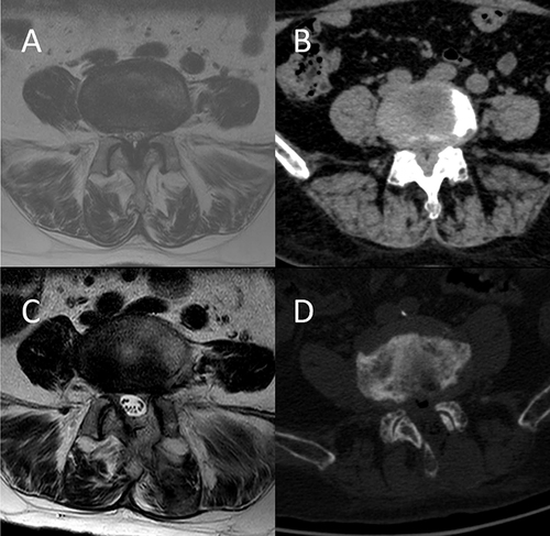 Figure 3 Typical case: A 75-year-old female patient complained of neurogenic claudication and was diagnosed with L4-5 degenerative lumbar spinal stenosis. (A and B) Preoperative axial MR and CT images at L4-5. (C and D) Postoperative axial MR and CT images.
