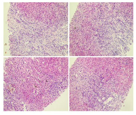 Figure 1 Histologic findings of acute rejection after liver transplantation. The histologic characteristics indicated acute injection, including normal structure of hepatic lobules, fibrous proliferation of interlobular portal area, small bile-duct hyperplasia, visible lymphocyte infiltration around the small bile-duct wall, liver cell mild edema with cholestasis, and point necrosis.