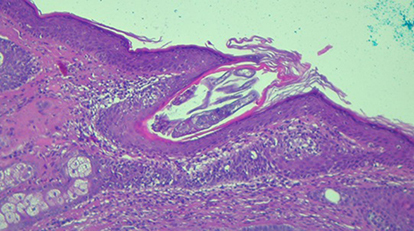 Figure 2 Histologic aspect of Demodex mite in pilosebaceous unit.