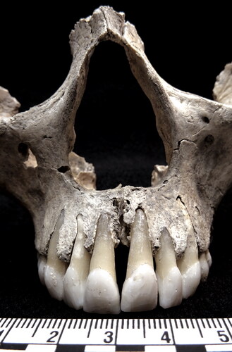 fig 12 Edix Hill 42B. Bilateral rounding of the nasal aperture margins and resorption of the nasal spine of EH-42B indicative of rhinomaxillary syndrome which would have caused soft tissue abnormalities. Scale in centimetres. Photograph by S Bohling with permission of Cambridgeshire County Council.