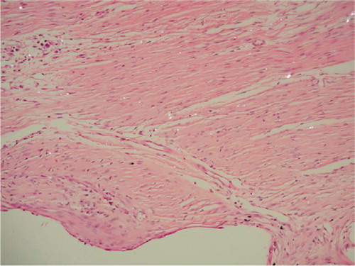 Figure 5. Fibrous membrane from an unstable PO implant. Hematoxylineosin stained section viewed with polarized light; 200 × The void down to the left represents the original placement of the porous implant. Birefringent PE particles can be seen scattered in a fibrous membrane dominated by fibroblasts. Only a few macrophages can be seen in the membrane.