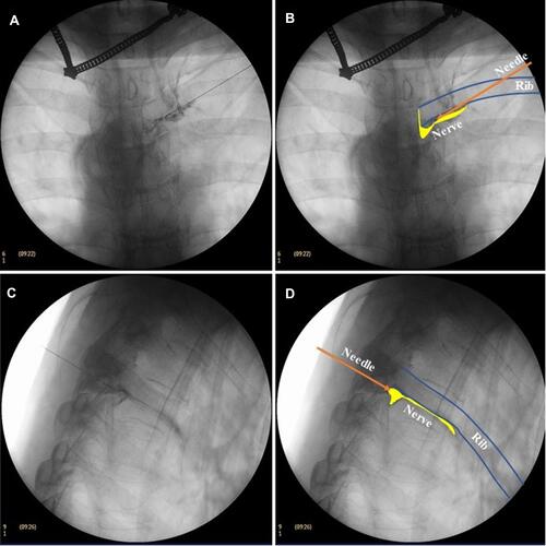 Figure 4 Neuroimaging. (A) In the AP view of fluoroscopy, the opaque agent showed that the thoracic nerve originated from the intraspinal nerve. It extended outward from the inferior border of the pedicle and continued along the inferior border of the rib. (B) Schematic diagram of neuroimaging in AP view on fluoroscopy. The yellow portion indicates the root of the thoracic nerve and the yellow swelling near the intervertebral foramen represents the dorsal root ganglion (DRG). (C) In the lateral view of fluoroscopy, the opaque agent showed that the nerve root appeared on the superior border of the foramen and ran along the inferior border of the rib. (D) Schematic diagram of neuroimaging in the lateral view on fluoroscopy. In yellow, the thoracic nerve root and DRG.