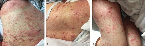 Figures 1, 2, and 3. demonstrate the leukemia cutis rash – generalized dense, symmetrical eruption composed of innumerable, erythematous papules with rough branny scale, forming scaly bumpy somewhat eczematous patches on many areas. Superimposed on these were scattered individual pustules, most notably on the thighs