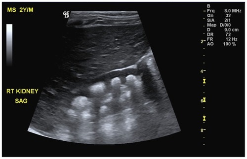 Figure 1 Sagittal ultrasound of the right kidney revealing presence of multiple crescent-shaped hyperechoic foci involving the renal pyramids consistent with renal medullary nephrocalcinosis.