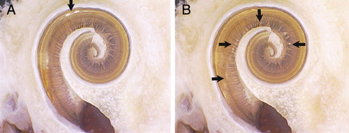 Figure 13. MRA (version 5) showing (A) sheath and array inserted and contact with the lateral wall and (B) after contact and full insertion with sheath removed. Images courtesy of UT Southwestern Medical Centre.