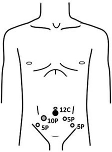 Figure 2 Port placement of laparoscopic radical prostatectomy.