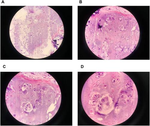 Figure 5 Photomicrograph histopathology of the biopsy showing, synovial hyperplasia, synovial loose bodies, sub synovial cartilaginous nodules (Hematoxylin Eosin staining Original magnification 40× in A, 100× in B, 200× in C, and 400× in D).