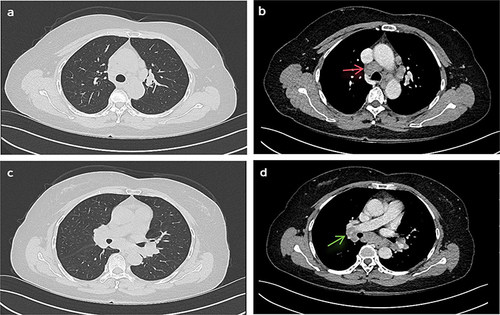 Figure 1 Chest CT showing enlarged (a and b) mediastinal (red arrows) and (c and d) hilar lymph nodes (green arrows) before treatment.