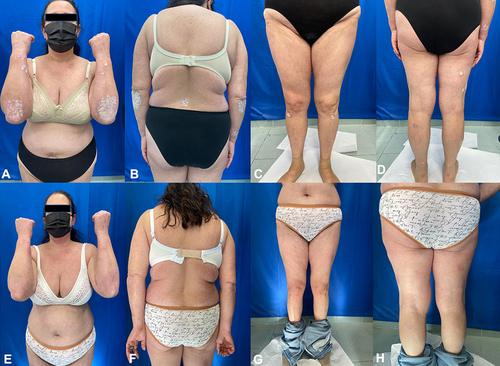 Figure 1 Patient at baseline (A–D) and after 4 weeks (E–H) of treatment with tildrakizumab.