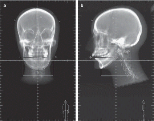 Figure 1 a. Example of bony structures outlined on the anterior reference image (DRR). b. Example of bony structures outlined on the lateral reference image (DRR).