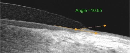 Figure 1 Measurement of conjunctival indentation.