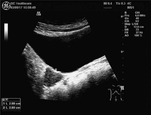 Figure 1 Abdominal ultrasound showed a 2.9×2.6 cm2 hypoechoic solid tumor with abundant blood flow signal.