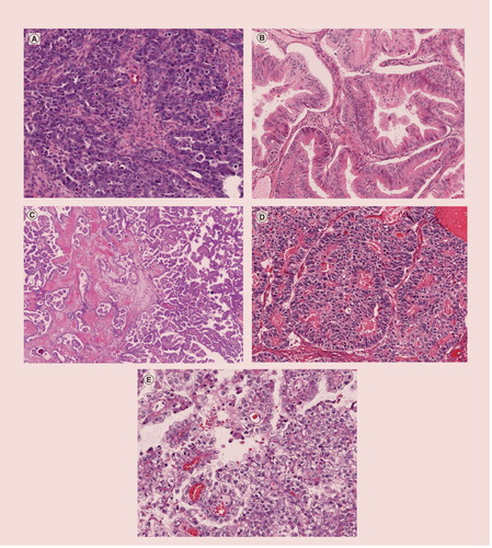 Figure 1. Representative photomicrographs of the five main subtypes of ovarian carcinomas.(A) High-grade serous carcinoma, (B) mucinous carcinoma, (C) low-grade serous carcinoma, (D) endometrioid carcinoma and (E) clear cell carcinoma.
