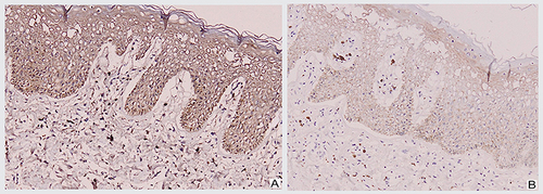 Figure 3 The result of immunohistochemical-staining. (A) Patchy p16 IHC staining was interpreted as p16-negative. (B) Weak and patchy p53 IHC staining was interpreted as p53-negative.