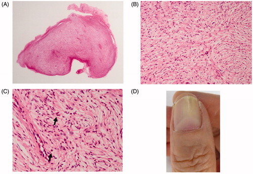Figure 3. Histopathological findings. (A) A loupe image. An incompletely encapsulated tumor. (B) A middle-power view. The tumor is composed of fine collagen fibers pointed in every direction. (C) A high-power view. Nuclei of the proliferating cells are spindle- or comma-shaped. Among the tumor cells, capillaries and a small number of mast cells are dispersed (indicated by arrows). (D) Appearance of new thumb nail six months postoperatively. This observation is natural.