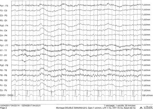 Figure 1 Continuous 17-hour video EEG monitoring.