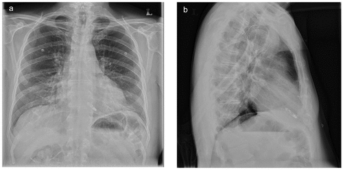Figure 2. Chest radiographs of a patient who underwent implantation of this leadless cardiac pacemaker are shown in the posteroanterior (Panel a) and lateral (Panel b) projections.