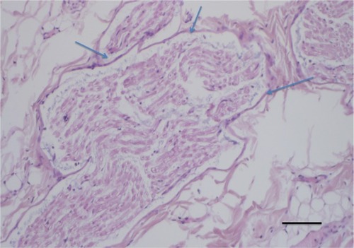 Figure 1 Hematoxylin and eosin staining showed all damage of the nerve, even damage close to (1 mm away from) the recurrent laryngeal nerve (arrows).