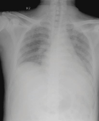 Figure 1. Chest radiograph found infiltration over the bilateral lower lungs in the emergency room.