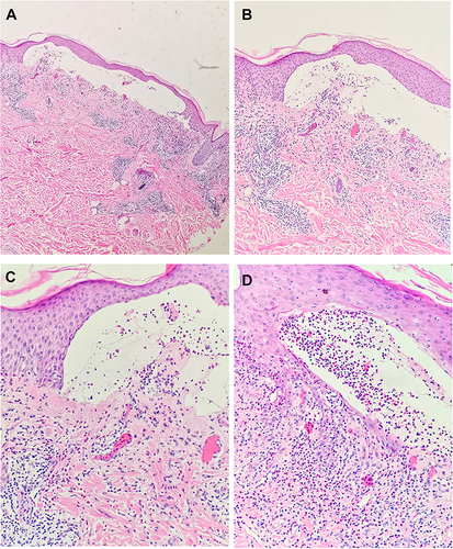 Figure 2 Pathology of skin biopsy from the lesions on the left thigh showed subepidermal blister formation with eosinophilic infiltrate, dermal vascular proliferation with lymphocytes, and eosinophil infiltration. (A) Magnification ×40, (B) magnification × 100, (C) magnification × 200, (D) magnification × 200.