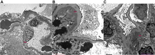 Figure 2 The deposition sites of immune complexes of HBV-GN. (A) Electron micrograph shows immune complexes deposit in mesangial regions and basement membrane; (B) immune complexes deposit in subendothelial regions; (C) immune complexes deposited in mesangial regions. The red arrows point to immune complexes.