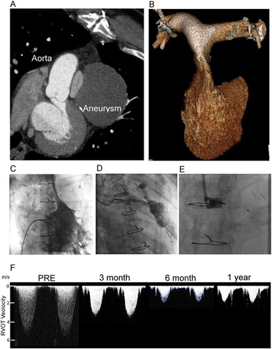 Figure 1. Acquired right ventricular outflow tract (RVOT) obstruction due to coronary graft aneurysm treated by percutaneous graft occlusion. (A) 2D multidetector computed tomography (MDCT) showing compression of the pulmonary valve between the graft aneurysm and the native aorta. (B) 3D MDCT reconstruction of the RV and pulmonary arteries showing the slit-like appearance of the main pulmonary artery. (C) Right ventriculography shows a minimum dimension of 2.2 mm, with an invasive pressure of 83 mmHg. (D) Graft angiography demonstrates the large aneurysm and feeding vessel. (E) An 8-mm AVPII device was used to occlude the graft with the expectation that thrombus would form and ultimately resorb. (F) Serial non-invasive Doppler assessments of the RVOT velocity show progressive and then stable reduction from 5.1 m/s at presentation to 1.7 m/s in follow up. RV dimensions, and hypertrophy normalize over this period. The patient was well and able to return to work at 6 months